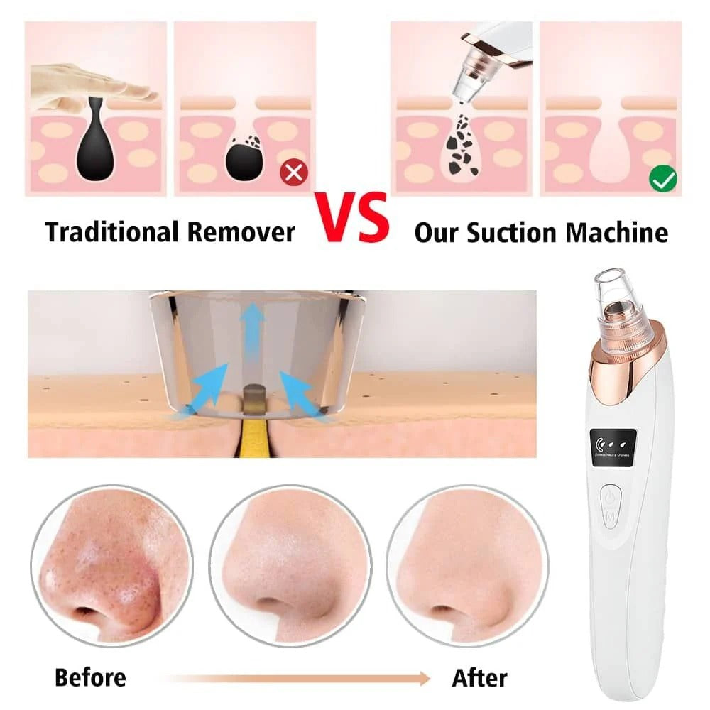 Electric Blackhead Remover | Vacuum Acne & Pore Cleaner | 5 Heads Suction Machine | Skin Care & Exfoliating Tool